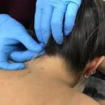 Punción seca en el Síndrome del Dolor Miofacial
