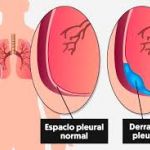 CUIDADOS Y MANEJO DEL DRENAJE PLEURAL ED.1