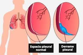 CURSO :CUIDADOS Y MANEJO DEL DRENAJE PLEURAL ED.2