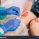Curso Manejo Avanzado de Heridas Complejas Ed.2