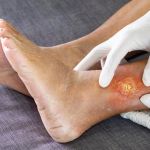 CURSO: ESTRATEGIAS DE CUIDADOS EN HERIDAS DE DIFÍCIL CICATRIZACIÓN. TERAPIAS AVANZADAS edición 1